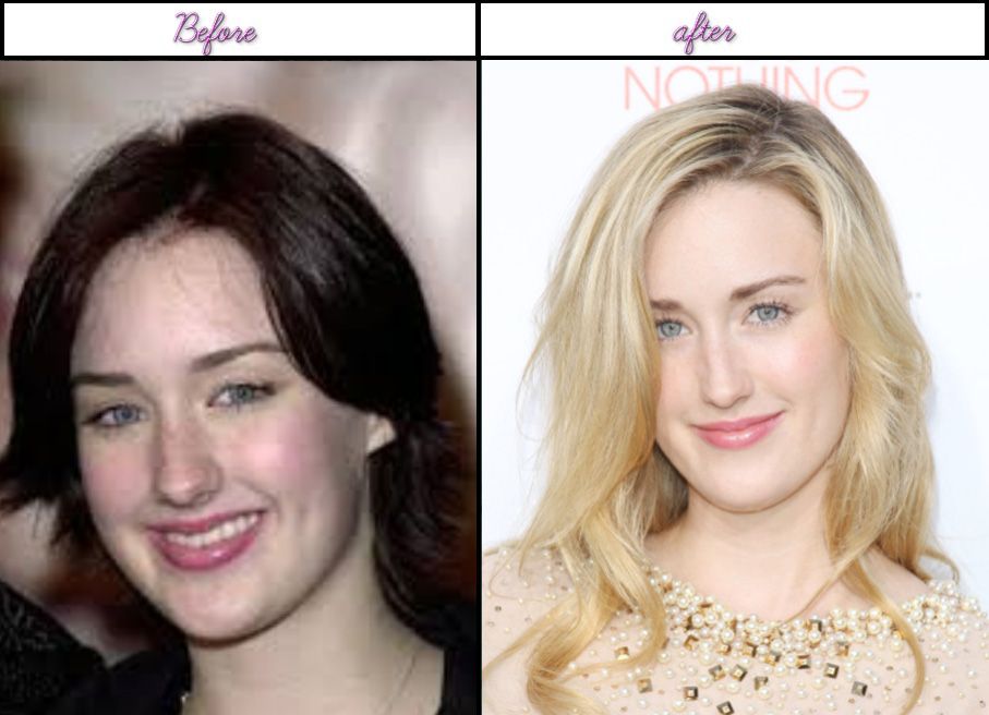 Ashley Johnson botox