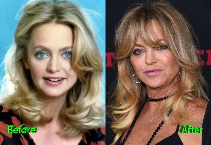 Goldie Hawn botox