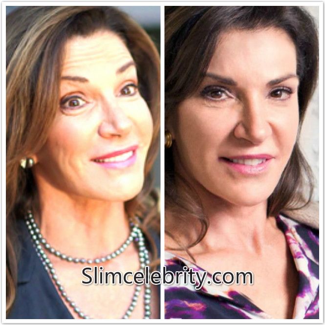 Hilary Farr botox