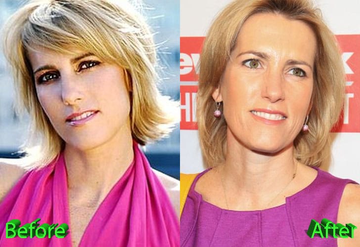 Laura Ingraham plastic surgery