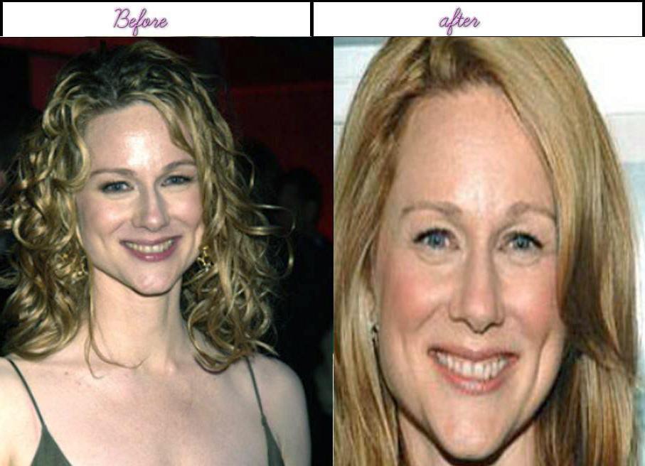 Laura Linney facelift